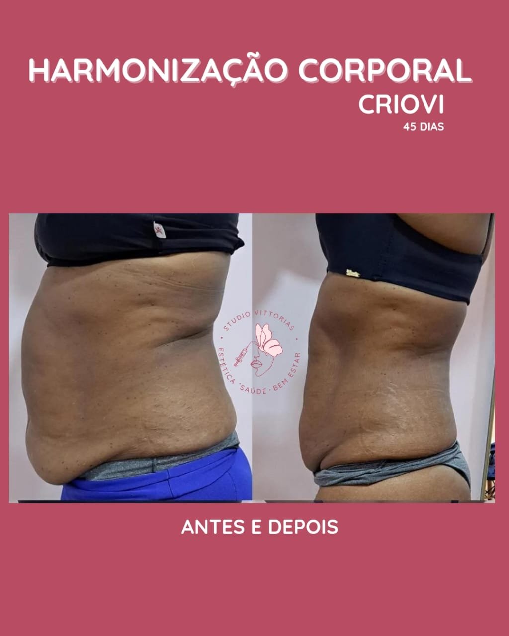 Antes e depois de Criovi, registro individual da Estética Vittorias