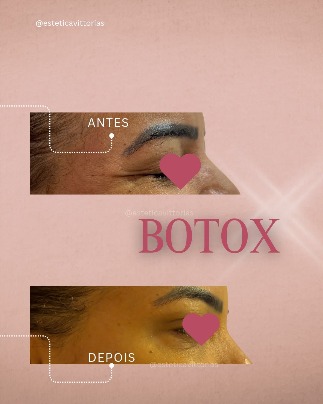Antes e depois de Botox, registro individual da Estética Vittorias