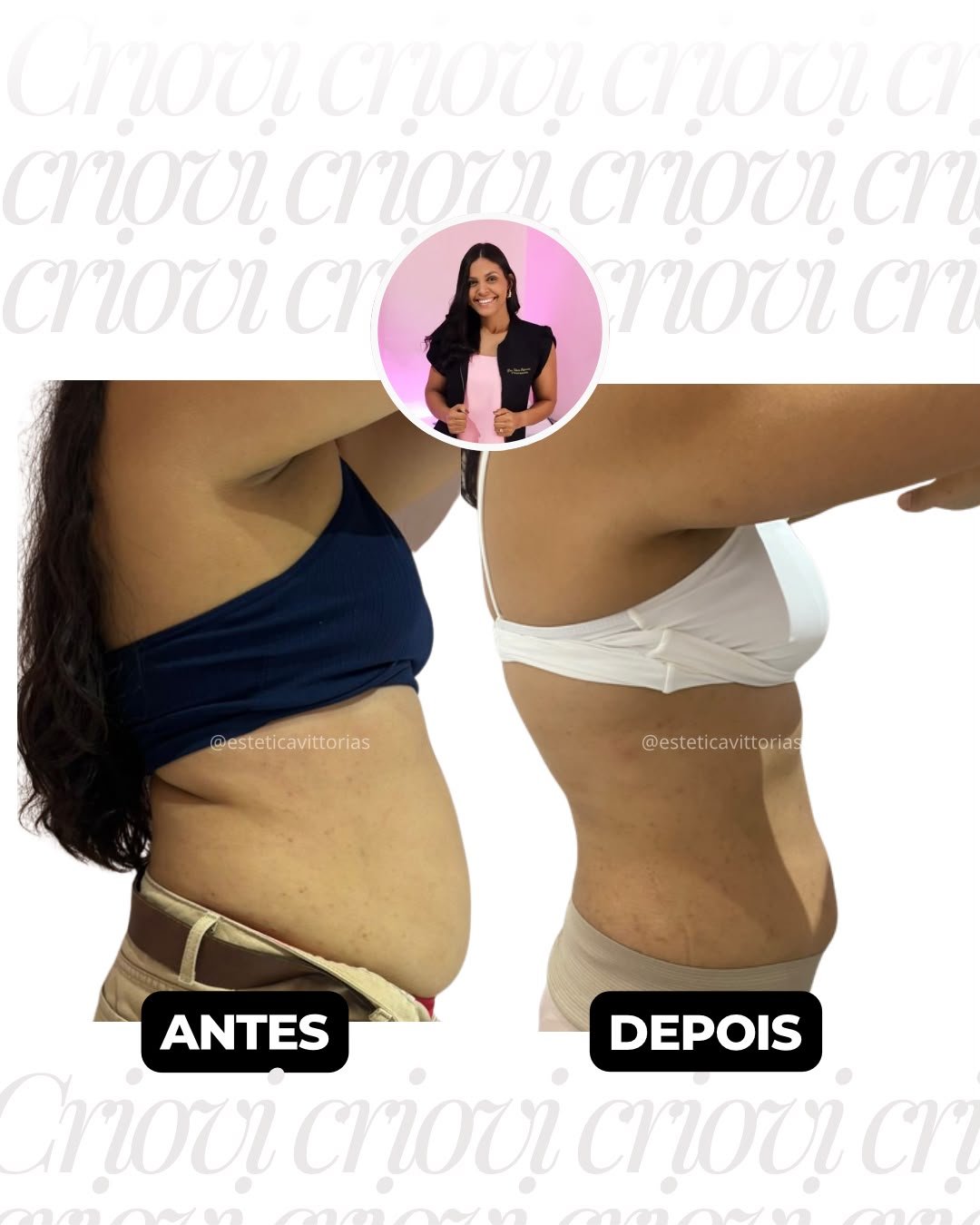 Antes e depois de Criovi, registro individual da Estética Vittorias
