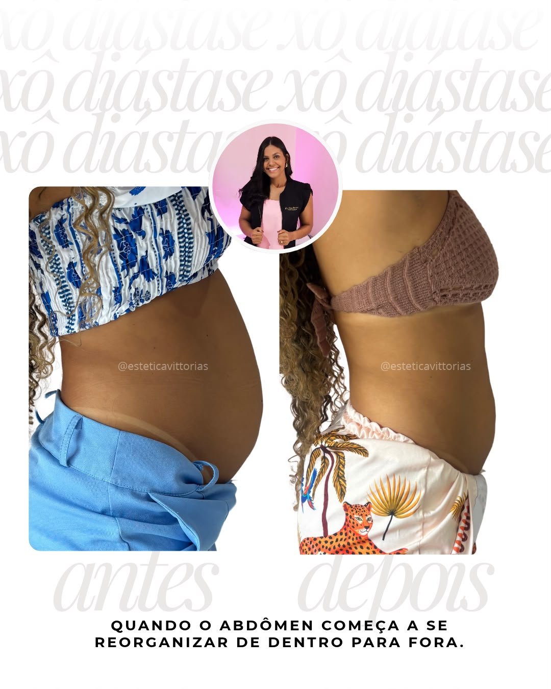 Antes e depois de Diástase, registro individual da Estética Vittorias
