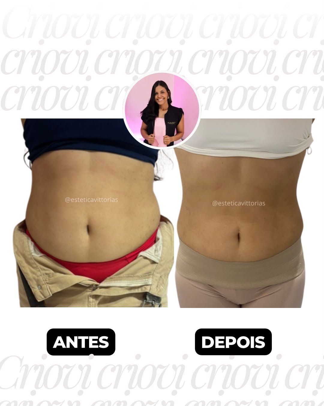 Antes e depois de Criovi, registro individual da Estética Vittorias