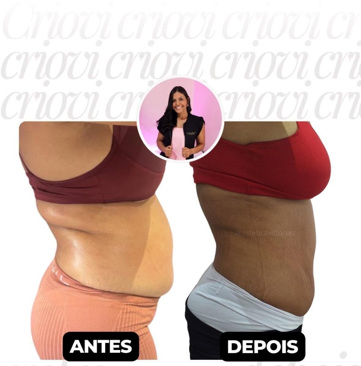 Antes e depois de Criovi, registro individual da Estética Vittorias