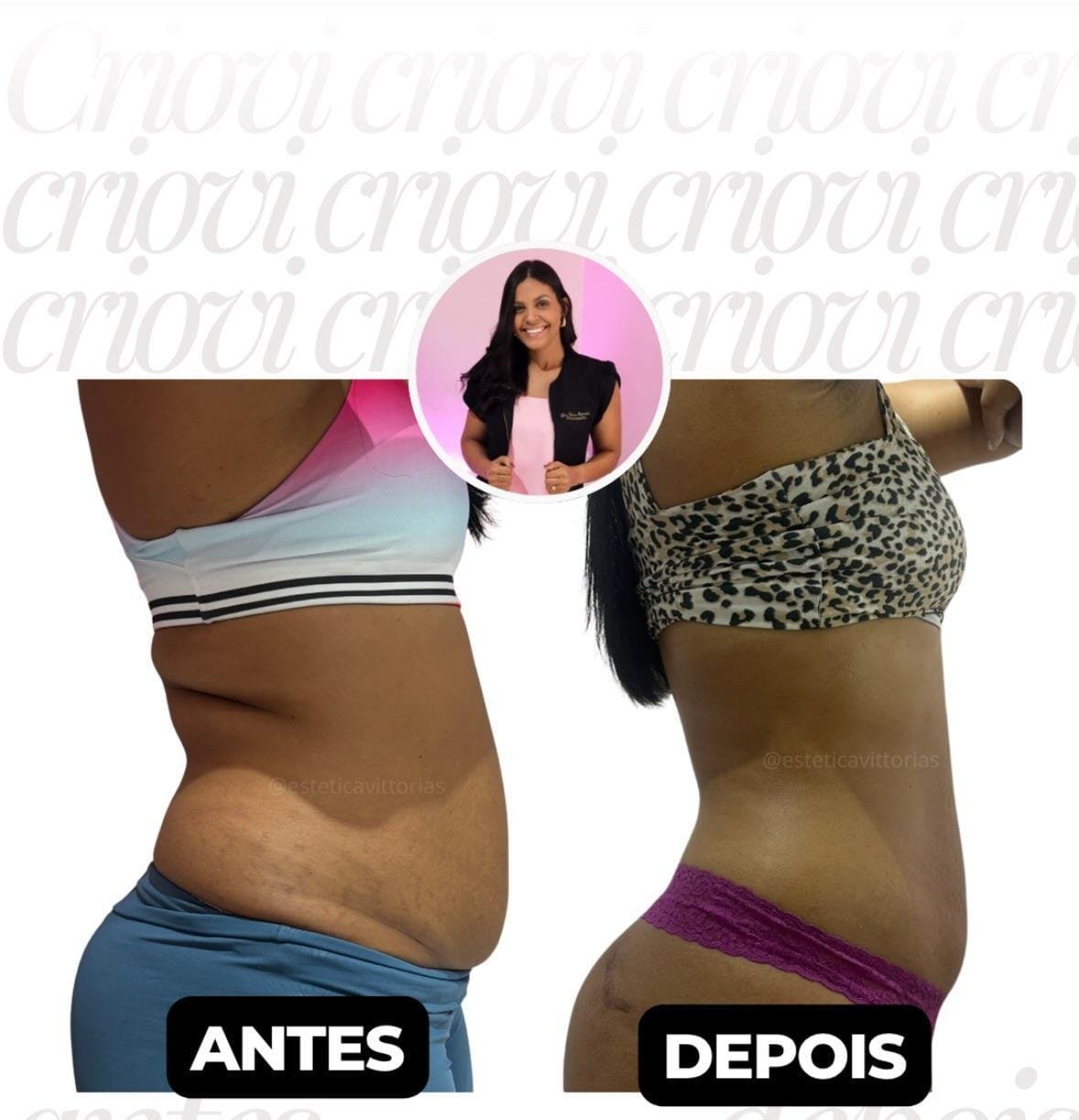 Antes e depois de Criovi, registro individual da Estética Vittorias