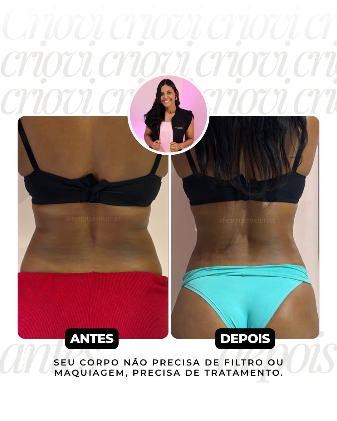 Antes e depois de Criovi, registro individual da Estética Vittorias