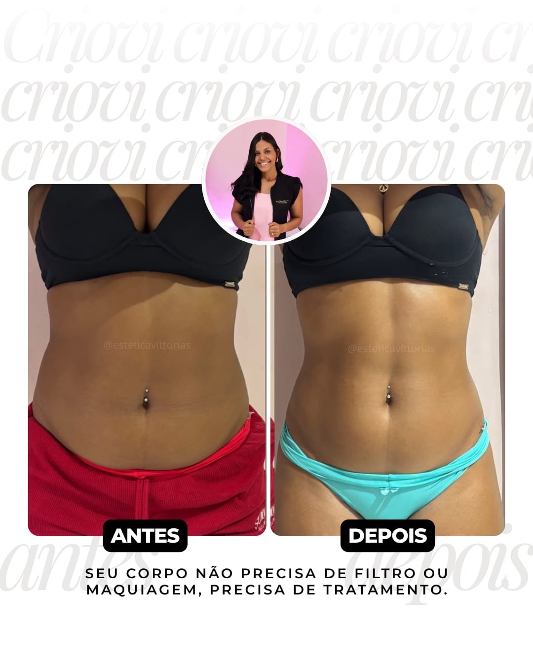 Antes e depois de Criovi, registro individual da Estética Vittorias