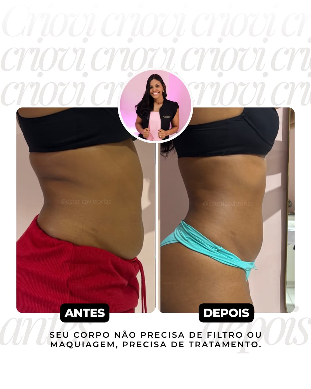 Antes e depois de Criovi, registro individual da Estética Vittorias