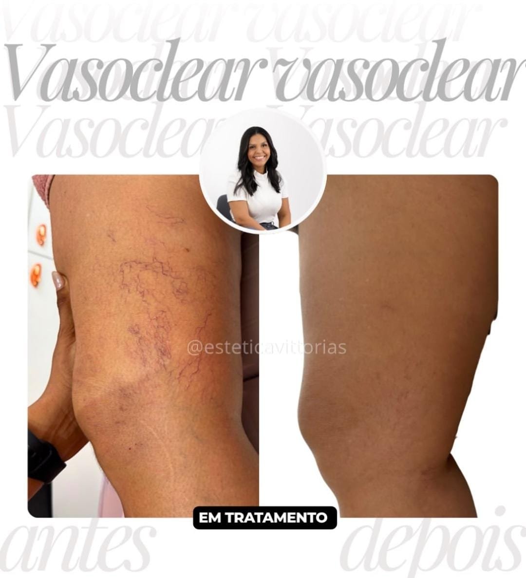 Comparativo de antes e depois de Vasoclear