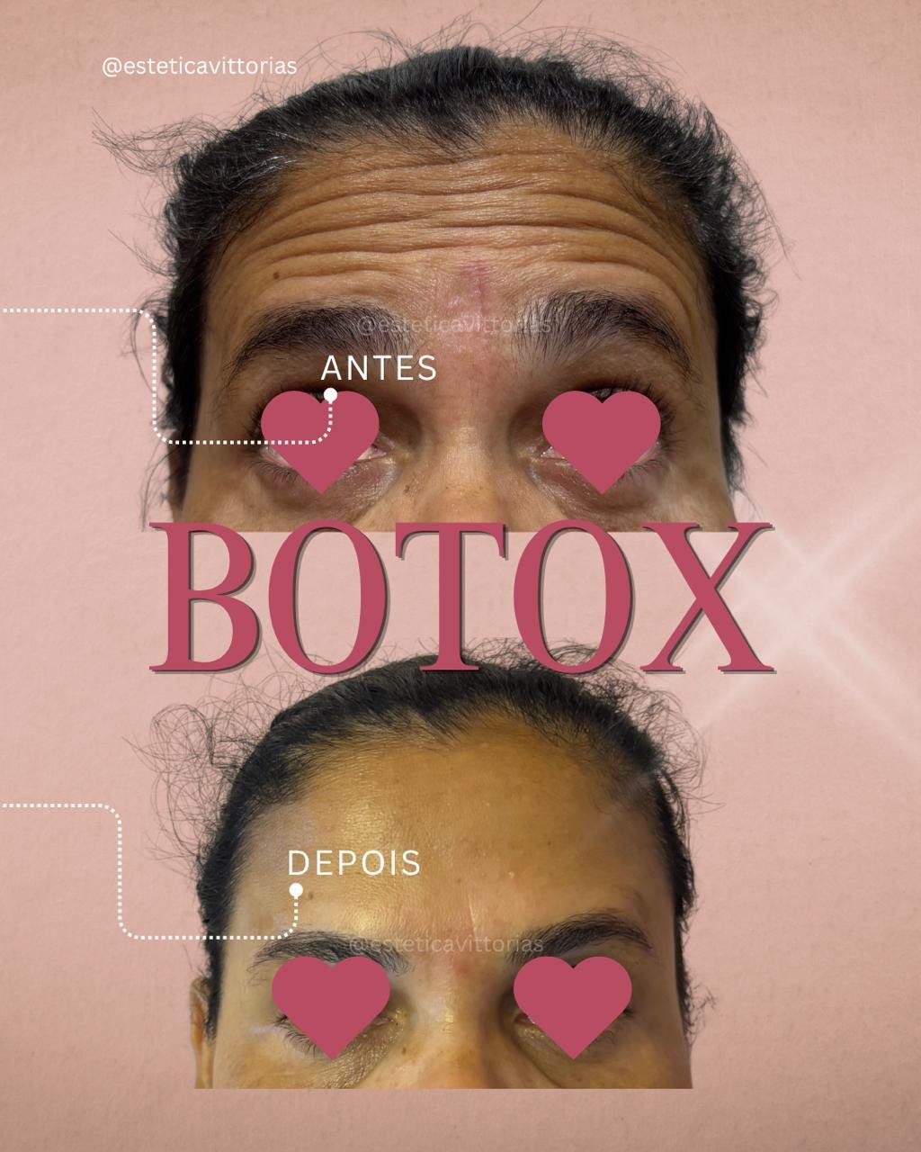 Antes e depois de Botox, registro individual da Estética Vittorias