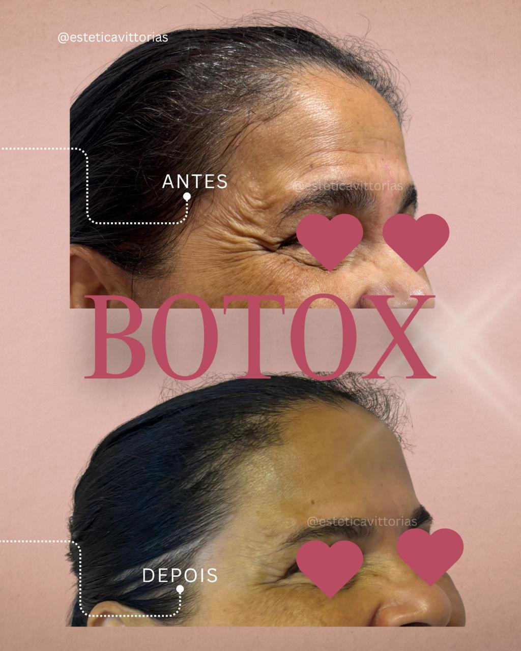 Antes e depois de Botox, registro individual da Estética Vittorias