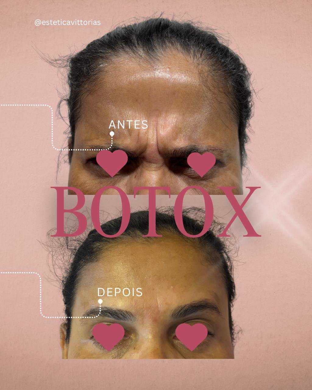 Antes e depois de Botox, registro individual da Estética Vittorias