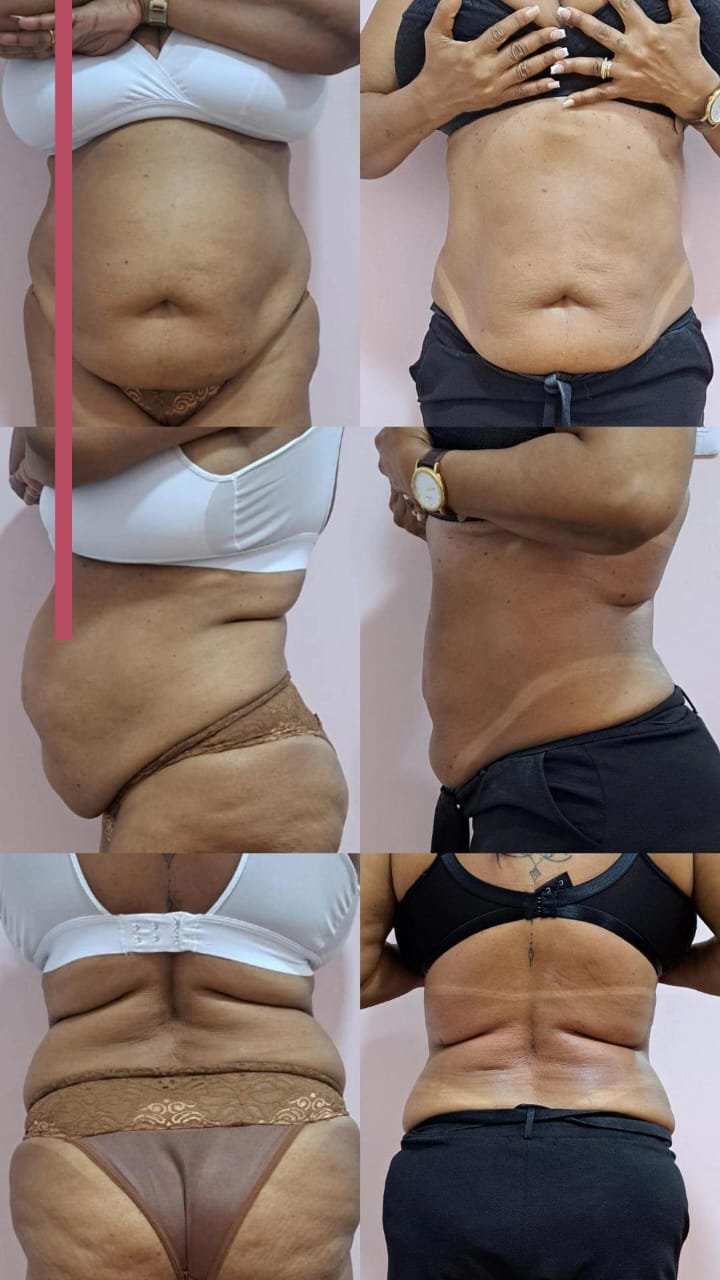 Comparativo de antes e depois de Criovi