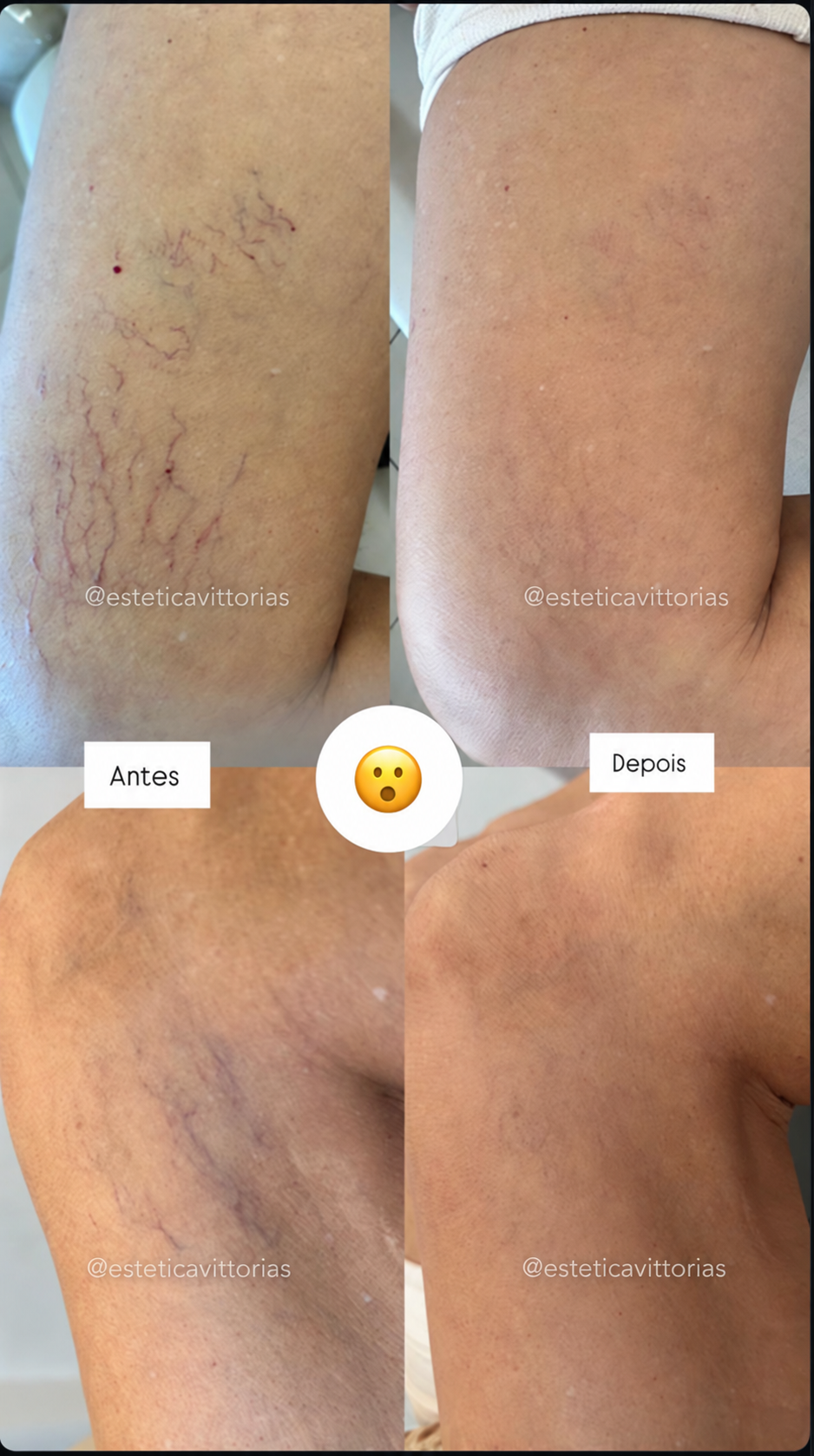 Antes e depois de Vasoclear, registro individual da Estética Vittorias