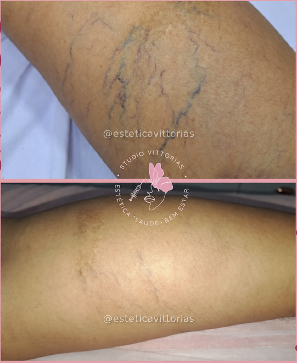 Antes e depois de Vasoclear, registro individual da Estética Vittorias